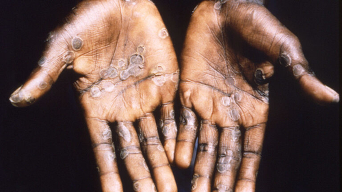 Últimas notícias da empresa sobre A manifestação de Monkeypox levanta ‘o risco moderado’ à saúde pública global, o WHO diz